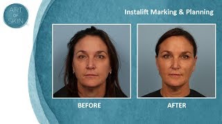 Instalift marking and planning nonsurgical facelift