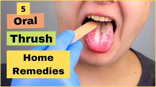 How To Treat Oral Thrush Oral Candidiasis Or Yeast Infection At Home | Best Home Remedies