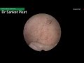 hysteroscopic polypectomy slicing technique polyp removal surgery