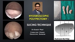 Hysteroscopic Polypectomy- Slicing Technique - Polyp removal surgery