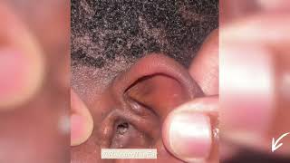 Earwax Removal Gone Wrong? Watch This  Africa Man's  Deep Clean!\