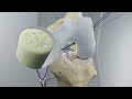 BEAR Implant Procedure  Step-by-Step Animation  Miach Orthopaedics