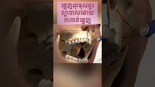 #ពត់ធ្មេញ #dentalcare #dentalclinic #braces #orthodontics #crossbite