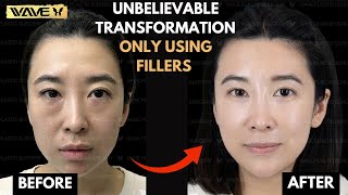 Full Face Transformation: Using nothing but fillers! | Pyramid Rejuvenation w/ Dermal Fillers