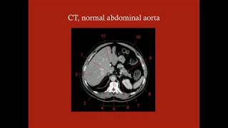 Abdominal Aortic Aneurysm - CRASH! Medical Review Series