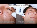 Phenol Peel Treatment for Acne Scars