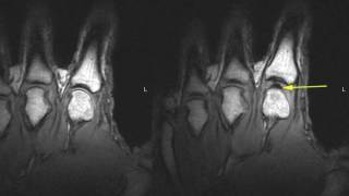 Why do our joints 'crack'?  -  Real Time Visualization via MRI