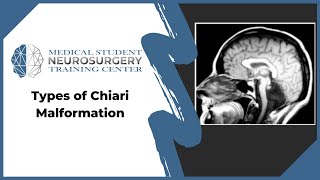 Types of Chiari Malformation