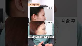 효과대박 동안시술 이거 3개만 알면 끝!! feat. 시술 한달차 전후 *모든 시술/수술은 부작용이 있을 수 있습니다 #모즈클리닉