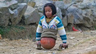 This girl has a BASKETBALL for LEGS! Amazing story