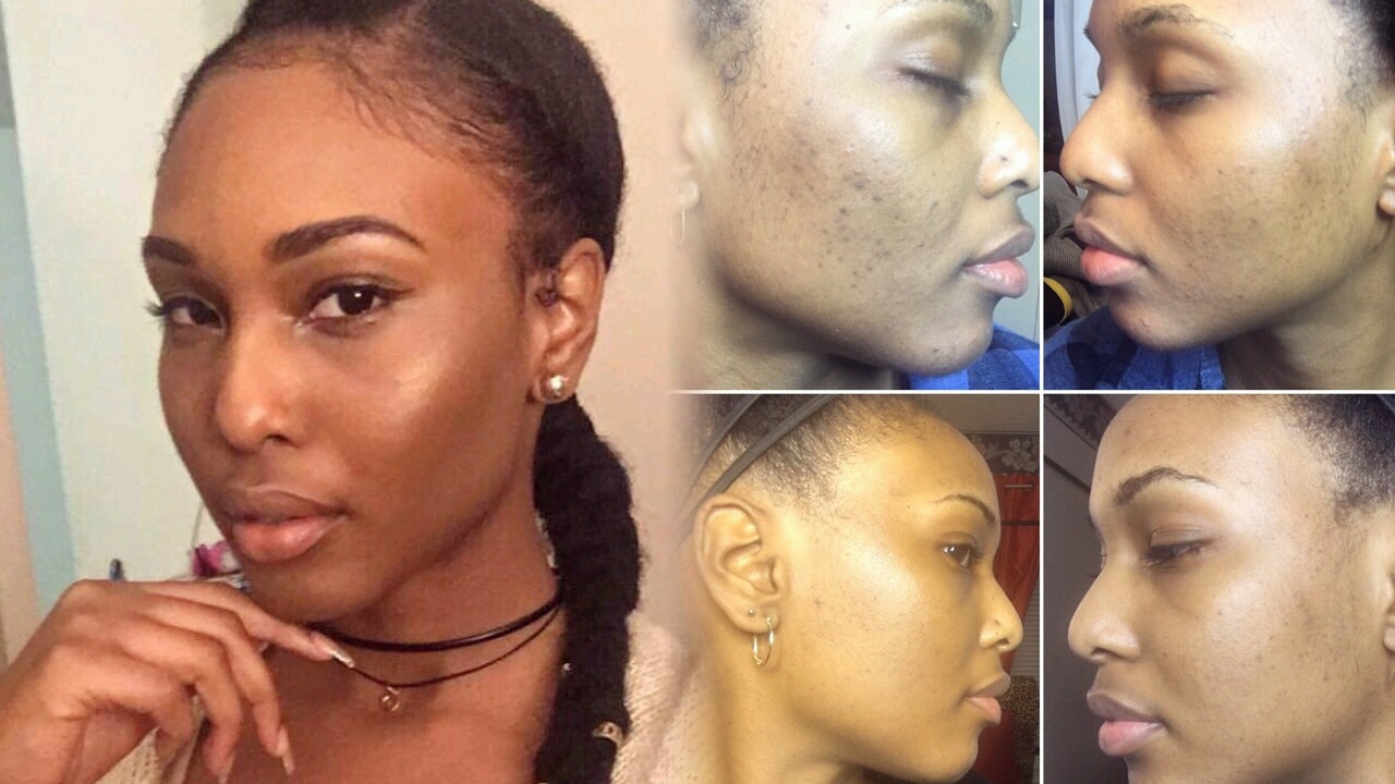 My Skin Routine Healing Hyperpigmentation Youtube