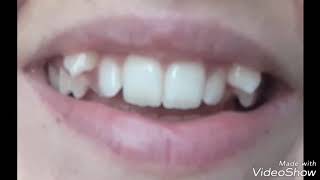 Dentes encavalados. 5 meses de tratamento odontológico