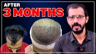 #AskDrJohnWatts | Vijay's Hair Transplant Journey after 3 Months | Hair Specialist Explains