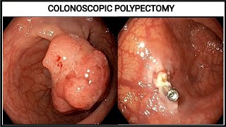 Polypectomy ll Hemostasis Clips Application #BD_ENDOSCOPY