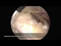 arthroscopic latarjet procedure combined with bankart repair...