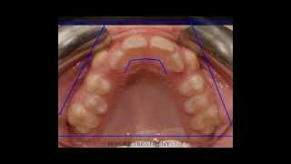 Non-Extraction Orthodontic (Braces) Treatment - Narrow Upper Jaw \u0026 Headaches - OASIS DENTAL MILTON