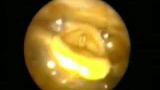 Chondronecrosis of the Larynx | Surgical Procedure