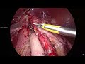 lap redo fundoplication revision hiatus repair