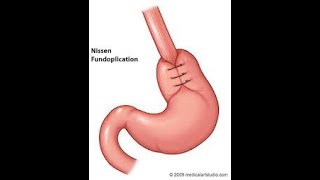 Lap Redo fundoplication: Revision Hiatus repair