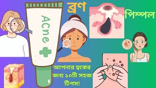 ব্রণ থেকে মুক্তির সহজ উপায় | 10 proven tips to Banish acne Fast!