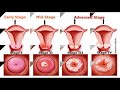 how to prevent cervical cancer የመሀፀን ጫፍ ካንሰር እንዴት መከላከል እንችላለን