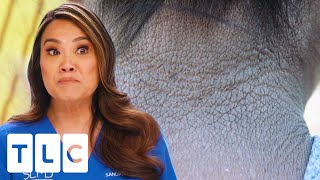 Woman With ELEPHANT SKIN Slaps Her Body To Avoid Irritation | Dr. Pimple Popper