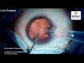 live surgery from nandadeep eye hospital dr sourabh patwardhan