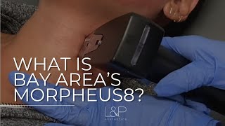 What is Morpheus8? Bay Area, CA