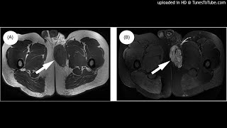 Proximal-type epithelioid sarcoma (ES) with a diffuse myxoid stroma