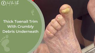 Thick Toenail Trim With Crumbly Debris Underneath