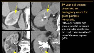 CT of Calyceal Abnormalities in the Kidney: Pearls and Pitfalls