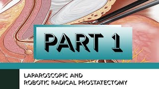 Laparoscopic and Robotic Radical Prostatectomy | Part I | Surgical Procedure