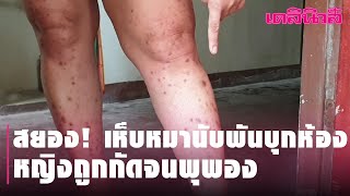 สยอง! เห็บหมานับพันบุกห้องเคหะ หญิงถูกกัดจนพุพอง | Dailynews