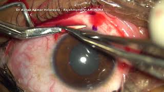 New Technique in Pterygium surgery