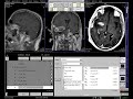 mri perfusion