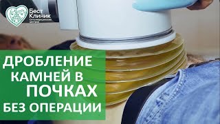 Камни в почках без операции. 💎 Лечение камней в почках без операции. Бест Клиник.