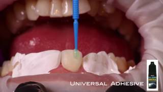 Bonded Functional Esthetic Prototype (BFEP) Individualized. Powered by Dr. Ed. Mclaren. PRESS HD