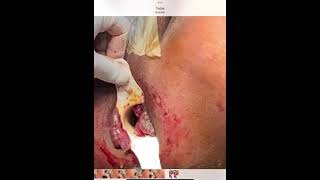 Laser Hemorrhoidoplasty (LHP), Laser Surgery for Piles (Laser Hemorrhoidoplasty Surgery)