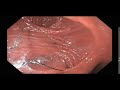 dialated gastro jejunal anastomosis after gastric bypass 2