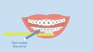Take Care of Your New Braces with Family Orthodontics!