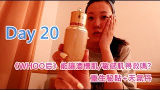 《WHOO 后》重生秘貼+天氣丹系列：酒槽肌使用實錄 DAY20