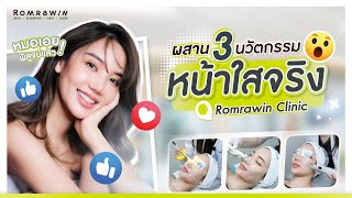 ผสาน 3 นวัตกรรมหน้าใสจริง! @RomrawinClinic หมอเอยพิสูจน์แล้ว!