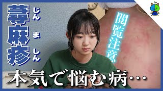 【病気】ここ数ヶ月本気で悩んでおりました…【蕁麻疹】