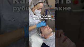 🤍Как убрать рубцы постакне? Проверенный способ #рубцы  #постакне #кожа #лазернаяшлифовка