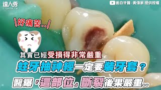 【蛀牙抽神經一定要裝牙套？醫曝「這部位」斷裂後果嚴重..】｜@JH_dentist