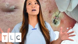 "The Award For The Biggest Blackhead" & A Juicy Cyst | Dr. Pimple Popper: This is Zit