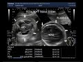 Ultrasound Video showing Fetal soft tissue edema with fetal ascites.