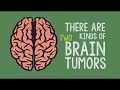 Primary and Secondary Brain Tumors | Dana-Farber Cancer Institute