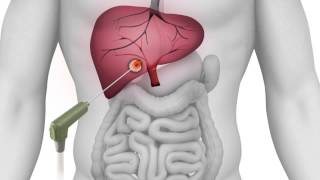 Microwave Ablation animation