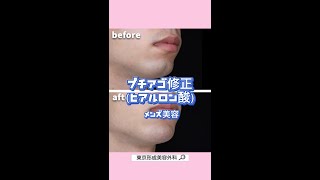 【男性症例】ヒアルロン酸で割れアゴ修正🌟#shorts